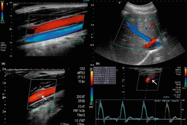 Understanding Edan's Color Flow Doppler Technology