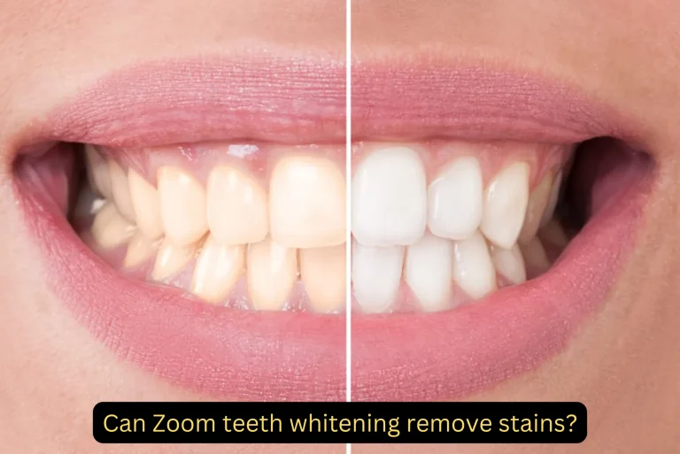 Can Zoom teeth whitening remove stains
