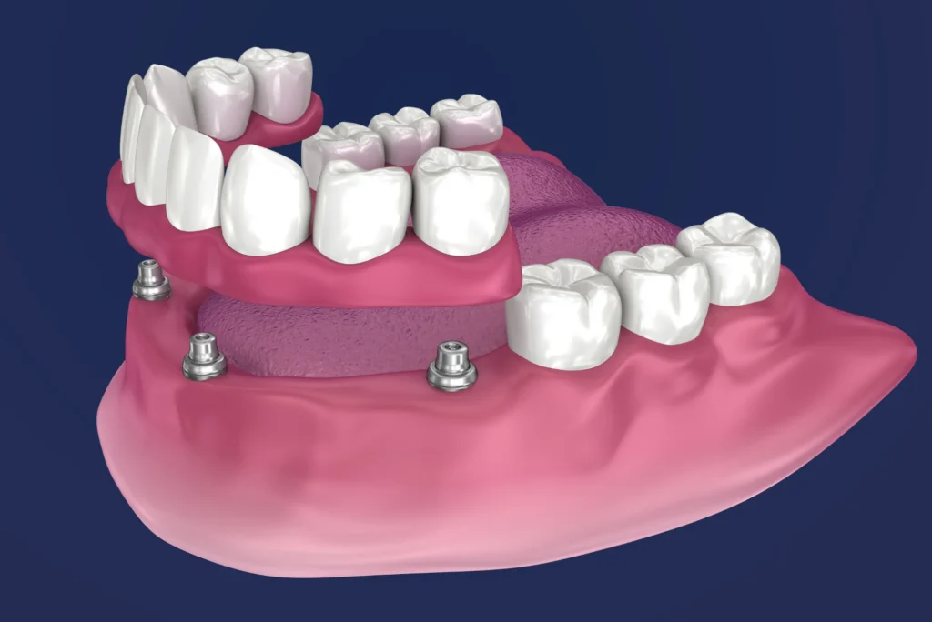 All-on-4 Dental Implants