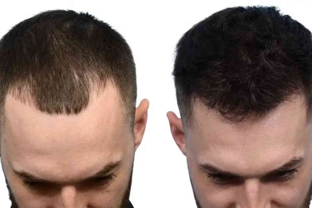 Hair Transplant Turkey