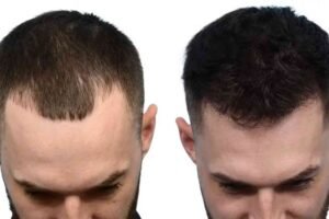 Best Hair Transplat Turkey (2)